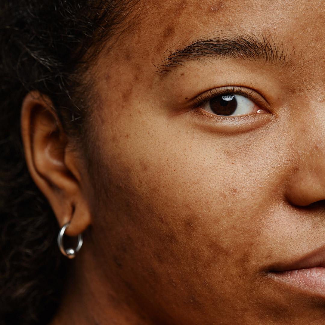 macro-shot-of-acne-scars-on-face-of-young-black-wo-2023-11-27-05-30-21-utc